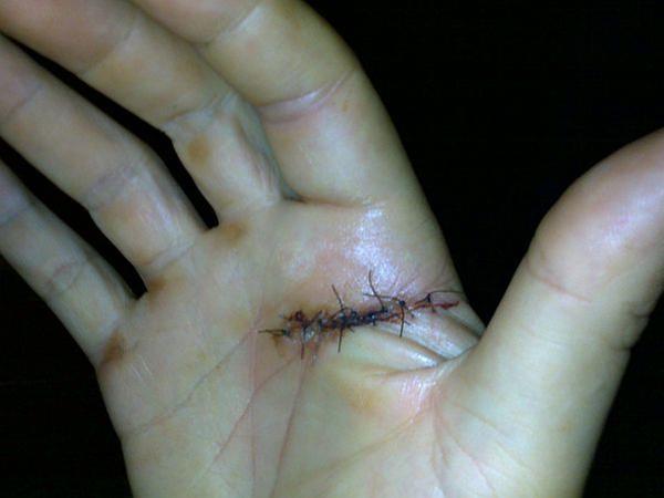 [Thumbnail for slicedhand.jpg]